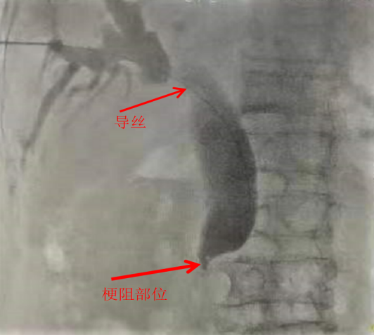 PTCD引流步骤1.png
